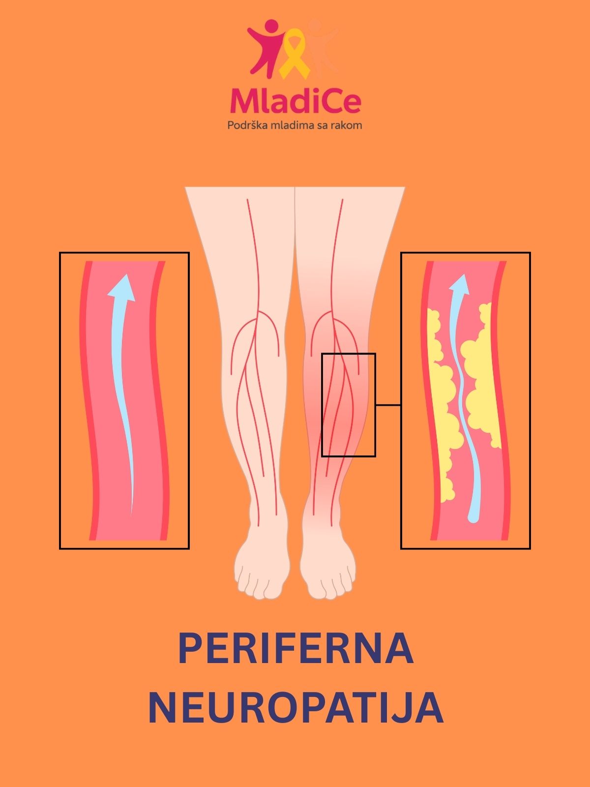 Naslovna: Periferna neuropatija